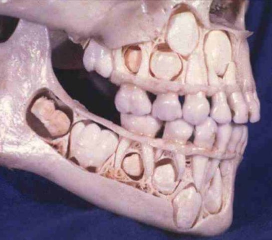 18. Bir çocuğun kafatası, bebek dişlerini kaybetmeden önceki hali