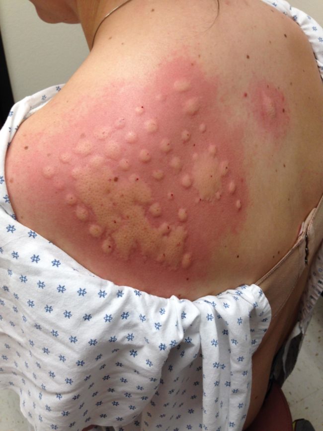 9. Alerji testi sonrası bir kızın geldiği durum. Özellikle atlara karşı alerjisi olduğu ortaya çıkmış.