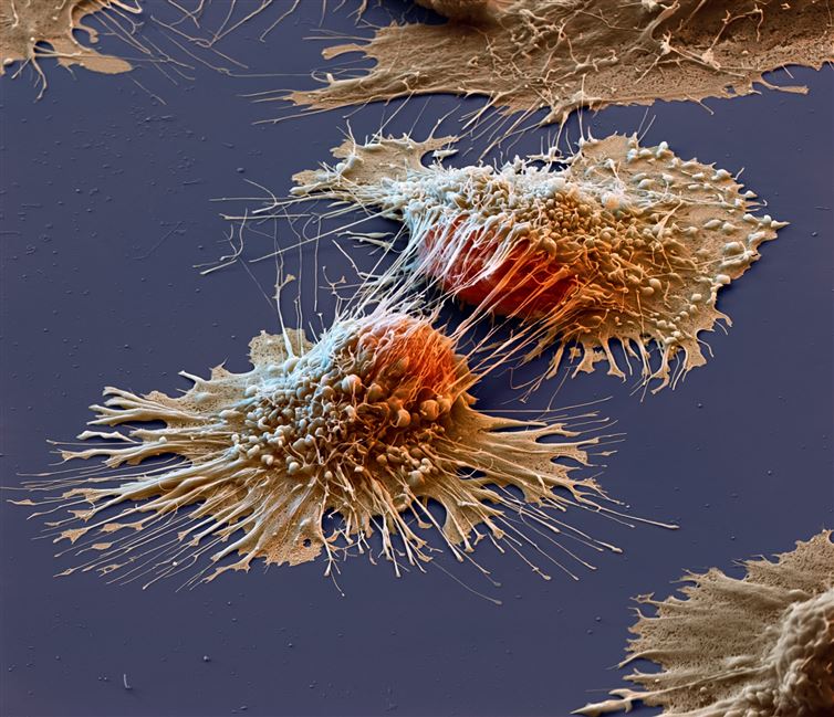 Bir kanser hücresinin mikroskop altındaki görüntüsü
