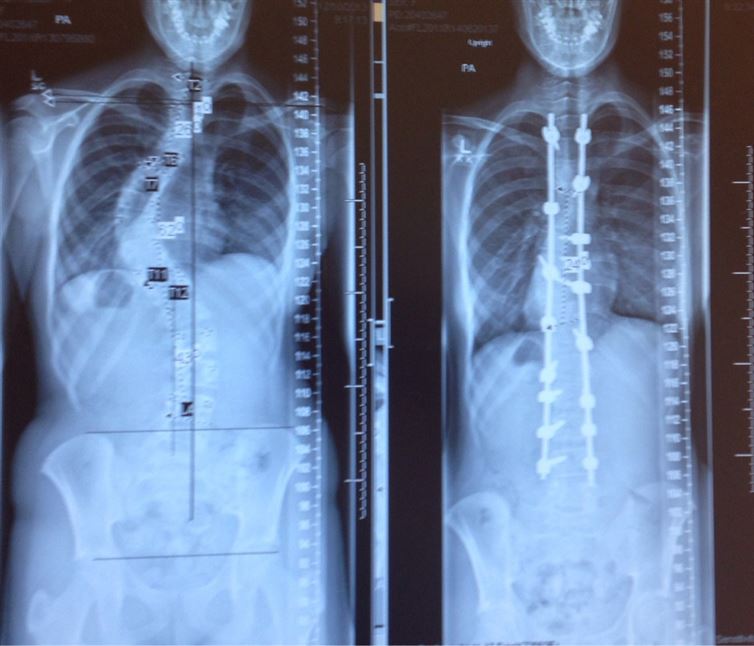 Skolyoz hastasının tedaviden önceki ve sonraki röntgeni
