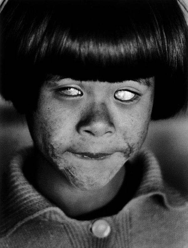 Hiroşima saldırısında kör kalan bir çocuk.