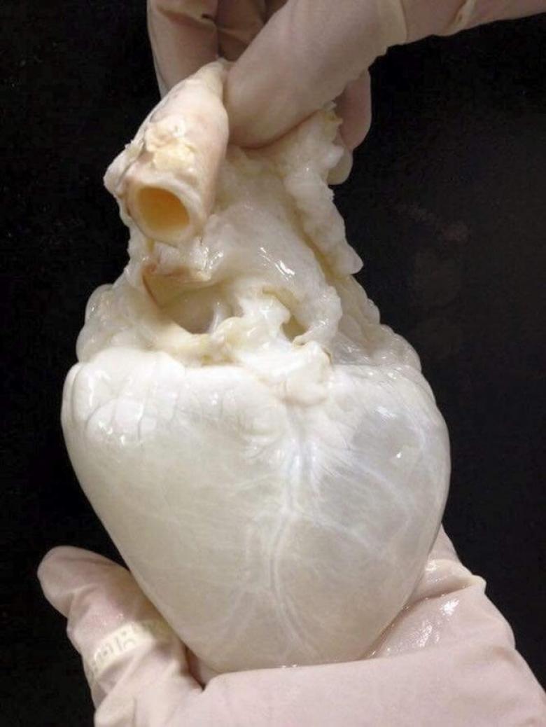6. Kalp nakli esnasında nakledilecek olan kalp...